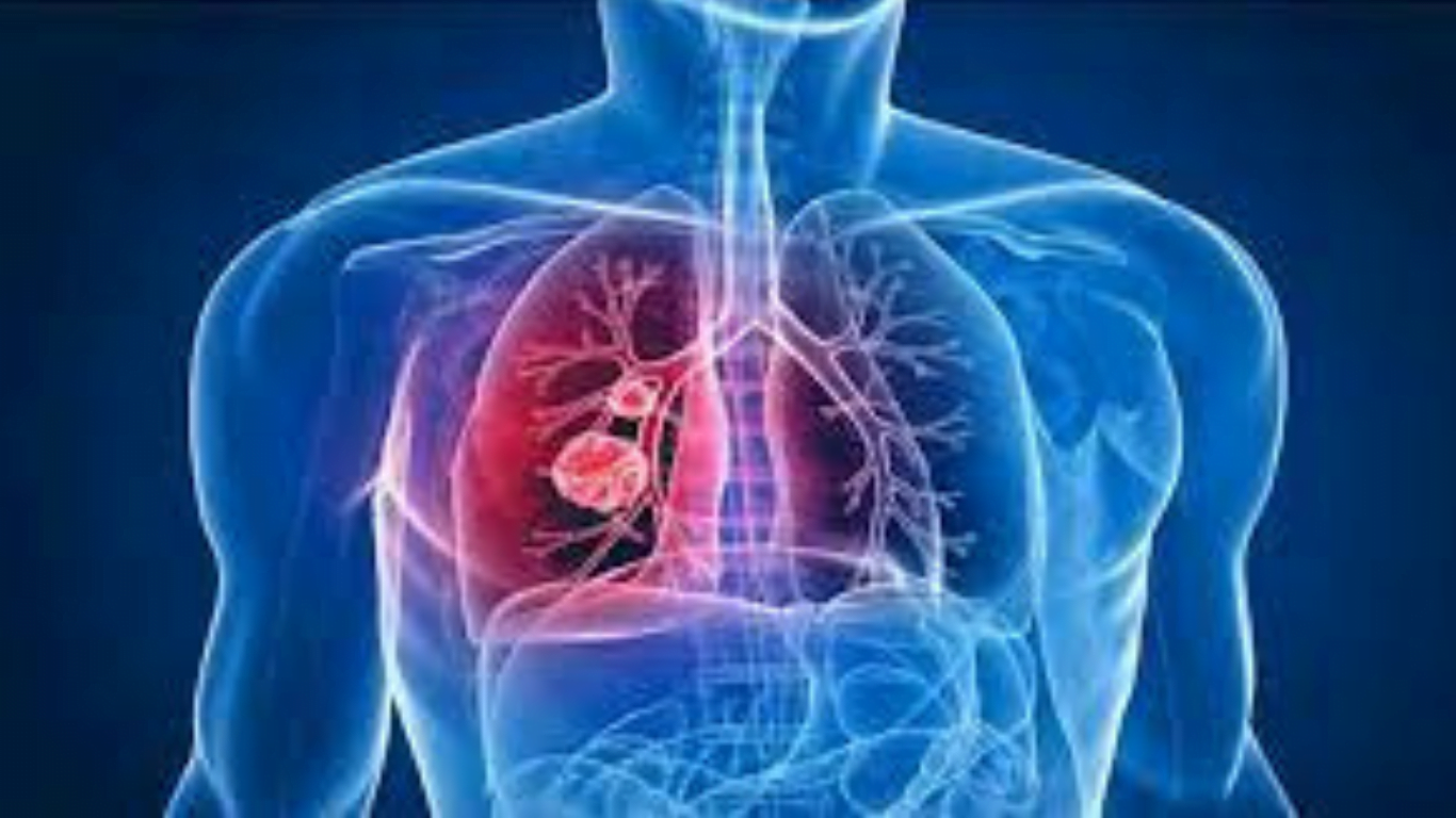 Em Taubaté, de 2019 a 2022, foram registrados 18 óbitos relacionados à Tuberculose e 356 casos da doença.