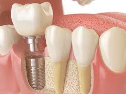 Dentista do Litoral vai entrar no Guinness Book com recorde de confecção de dentes
