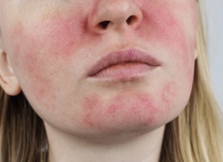 Rosácea: o que é? Tratamento para a doença foi tema no “Saúde diária”