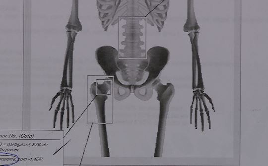 Número de pessoas com fratura de quadril cresce no Brasil; entenda o porquê
