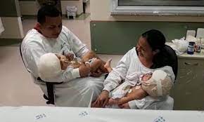 Gêmeas Siamesas deixam a CTI e vão para o quarto