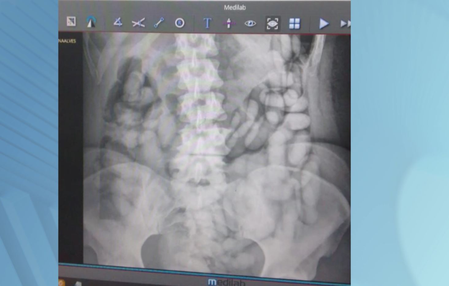 Mulher é presa ao tentar embarcar com drogas no estômago em Viracopos