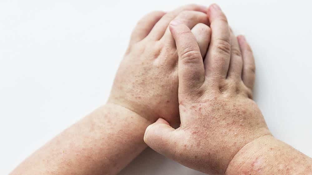 Casos de escarlatina aumentam 600% no último ano em Jacareí