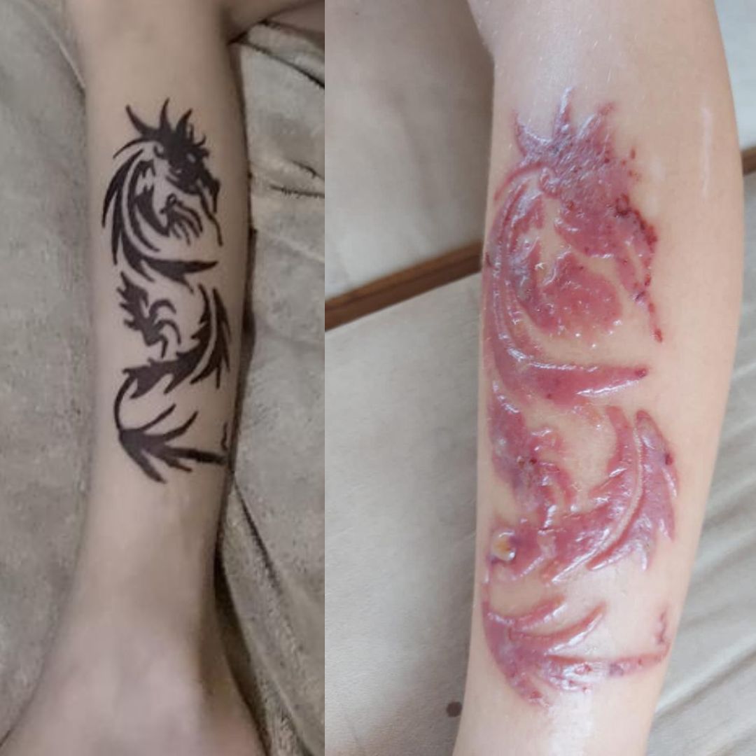 Alerta verão: menino de 8 anos tem reação alérgica após fazer tatuagem de henna