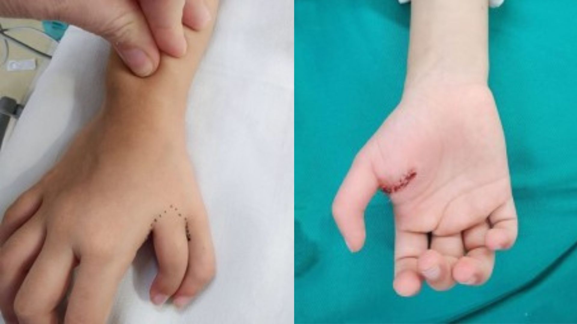 Hospital de Guarujá faz cirurgia pioneira na Baixada Santista