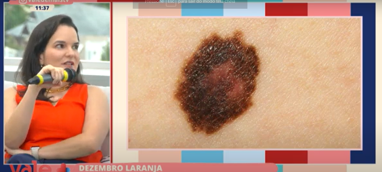 A campanha Dezembro Laranja conscientiza a população sobre a importância da prevenção contra o câncer de pele